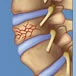 Fractura columna
