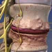 Infecciones de columna vertebral