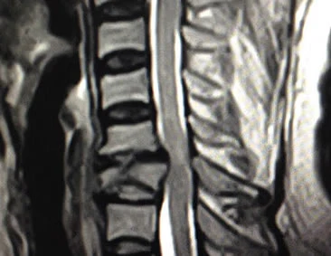 Tumor columna